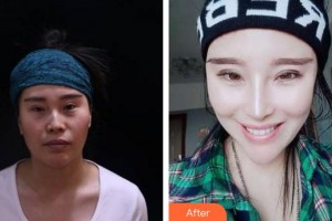 成都華西保健醫(yī)院整形美容中心馬樹林整形價格表附鼻部手術(shù)案例展示