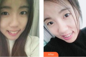 成都漢密爾頓美容醫(yī)院武剛整形價格表附金屬托槽矯正案例展示