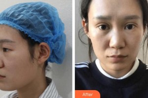 成都漢密爾頓美容醫(yī)院陳亮整形價格表附雙眼皮案例展示