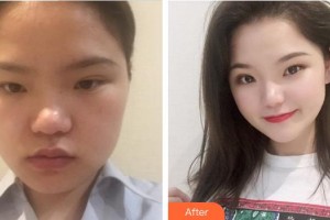 成都艾尚醫(yī)學(xué)美容門診部王濤整形價格表附發(fā)際線種植案例展示