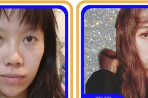 成都金榮醫(yī)學(xué)美容診所葛冬梅整形價格表附鼻部手術(shù)脂肪填充案例展示