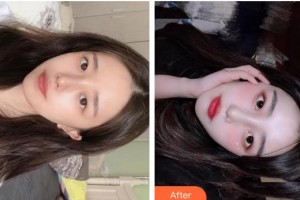 成都金榮醫(yī)學(xué)美容診所張高欣整形價格表附小氣泡案例展示