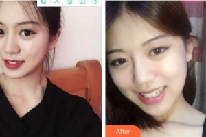 合肥劉大夫美容整形醫(yī)院呂希華整形價格表附面部吸脂案例展示