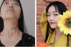 成都醫(yī)學(xué)院第一附屬醫(yī)院燒傷整形科馬兵整形價格表附祛疤案例展示