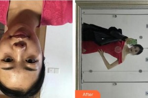 成都大華醫(yī)學(xué)美容醫(yī)院吳振裘整形價格表附點陣激光案例展示