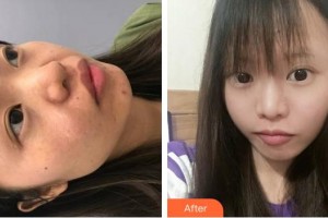 成都醫(yī)學(xué)院第一附屬醫(yī)院燒傷整形科劉漪淪整形價格表附祛疤案例展示