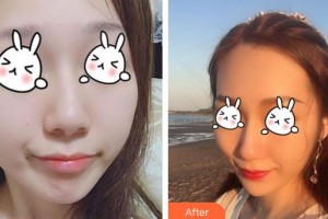 成都第六人民醫(yī)院醫(yī)學(xué)整形美容科趙蓉整形價格表附無針?biāo)獍咐故?>
</a>
<h3 class=