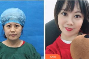 成都莊醫(yī)生醫(yī)學(xué)美容診所管太軍整形價格表附不開刀祛眼袋+自體脂肪填充淚案例展示