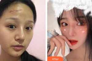 成都醫(yī)學(xué)院第一附屬醫(yī)院燒傷整形科劉月明整形價格表附離子束祛疤案例展示