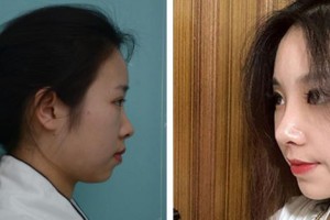 成都醫(yī)美整形美容醫(yī)院唐永實整形價格表附隆鼻案例展示