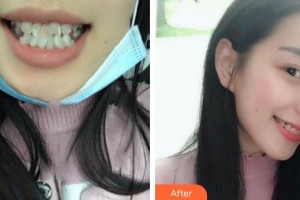 成都悅好醫(yī)學(xué)美容醫(yī)院謝蒂整形價格表附瓷貼面案例展示