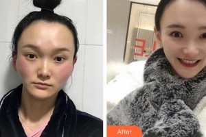 成都中華園整形美容醫(yī)院孫豪成整形價格表附顴骨顴弓案例展示