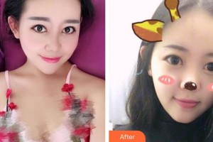 成都菲爾醫(yī)療美容門診部郝麗娜整形價格表附面部輪廓案例展示