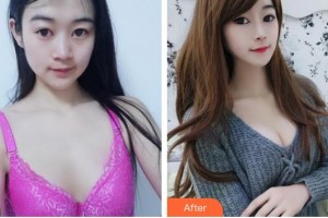 成都艾尚醫(yī)學(xué)美容門診部羅利達整形價格表附濃縮豐胸真實案例展示