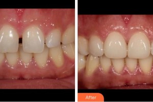 成都伊莎貝拉醫(yī)療美容門診部王殿玲整形價格表附瓷貼面一貼即白案例展示