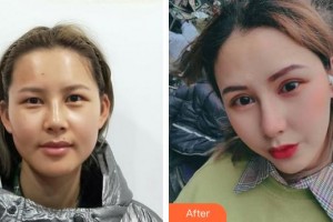 成都悅好醫(yī)學(xué)美容醫(yī)院李潤朱整形價格表附雙眼皮案例展示