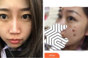 成都悅好醫(yī)學(xué)美容醫(yī)院陶曉蘋整形價格表附激光點痣案例展示