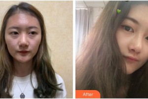 成都悅好醫(yī)學(xué)美容醫(yī)院文炯珍整形價格表附鼻部整形案例展示