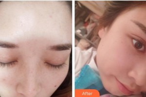 成都伊莎貝拉醫(yī)療美容門診部史寧整形價格表附祛斑案例展示