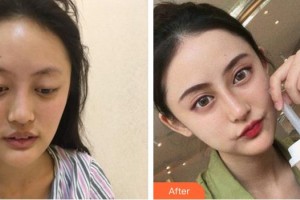 成都悅好醫(yī)學(xué)美容醫(yī)院韓炯逸整形價格表附鼻部手術(shù)案例展示