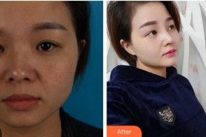 成都天使之翼醫(yī)學(xué)美容醫(yī)院郝勁偉整形價格表附鼻部綜合案例展示