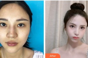 成都劉影美容整形門診部劉影整形價格表附眼瞼下至+面部吸脂+M唇案例展示