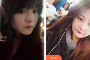 成都悅好醫(yī)學(xué)美容醫(yī)院徐凱整形價格表附牙齒根管調(diào)節(jié)案例展示