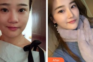 成都醫(yī)美整形美容醫(yī)院王俸棋整形價格表附鼻部綜合案例展示
