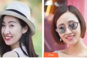 成都嘉美整形美容門診部梁尚爭整形價格表附口腔-牙齒矯正-隱形托槽矯正案例展示