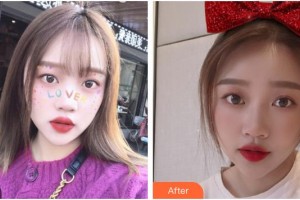 成都醫(yī)學(xué)院附屬整形美容醫(yī)院車墩發(fā)整形價格表附祛痘綜合案例展示