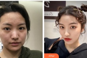 成都美瑞皮膚美容門診部馬維騏整形價格表附多方面部超激光美膚案例展示