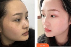 成都美瑞皮膚美容門診部黃紅琳整形價格表附激光祛斑案例展示