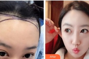 成都西區(qū)醫(yī)院醫(yī)學(xué)美容科蔡英整形價格表附發(fā)際線移植案例展示