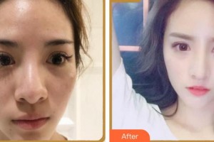 成都天使之翼醫(yī)學(xué)美容醫(yī)院李大光整形價格表附鼻部多項案例展示