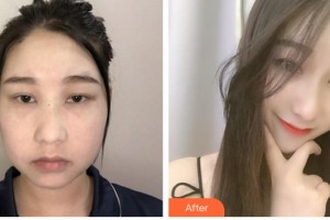 成都米蘭柏羽醫(yī)學(xué)美容醫(yī)院張峰整形價格表附埋線提升提升案例展示