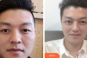 成都西區(qū)醫(yī)院醫(yī)學(xué)美容科孫文強整形價格表附切開雙眼皮案例展示