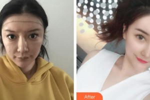 成都玉之光整形醫(yī)院劉中國整形價格表附發(fā)際線種植案例展示