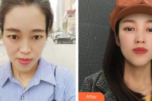 成都可思美醫(yī)學(xué)美容門診部潘紅偉整形價格表附眼部整形案例展示