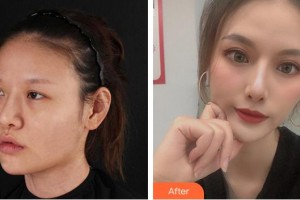 成都永康醫(yī)院整形美容科劉玉輝整形價格表附眼部整形案例展示