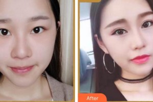 成都濟慈德美醫(yī)療美容門診部劉家亙整形價格表附眼部綜合案例展示