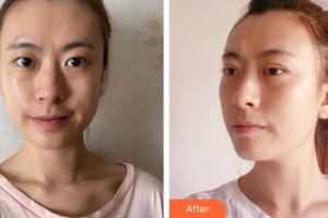 成都悅好醫(yī)學美容醫(yī)院高富雷整形價格表附眼部綜合案例展示