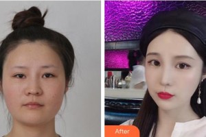 成都恩喜醫(yī)學整形美容醫(yī)院全載用整形價格表附射頻溶脂瘦臉+注射瘦臉案例展示