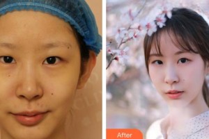 成都華倫鉑尚醫(yī)療美容診所吳細輕整形價格表附水光補水祛暗沉案例展示