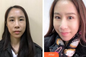 成都艾美醫(yī)療美容門診部魏東整形價(jià)格表附眼部綜合案例展示