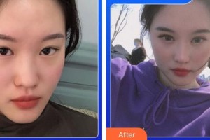 成都恩喜醫(yī)學(xué)整形美容醫(yī)院李光虎整形價(jià)格表附5S重瞼術(shù)+超微創(chuàng)開內(nèi)眥案例展示