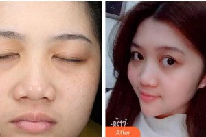 成都華康醫(yī)院美容整形外科李霞整形價(jià)格表附祛斑案例展示