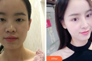成都艾尚醫(yī)學(xué)美容門診部秦虹整形價(jià)格表附鼻部綜合案例展示