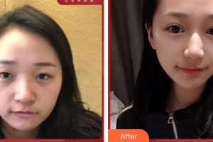 成都美極醫(yī)療美容門診部劉大琨整形價(jià)格表附切開雙眼皮案例展示