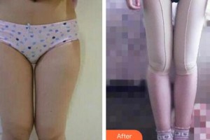 成都唯羅納醫(yī)療美容門診部李從從整形價(jià)格表附吸脂瘦大腿案例展示