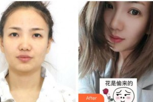 成都俏百顏美容整形醫(yī)院劉柏林整形價(jià)格表附雙眼皮案例展示